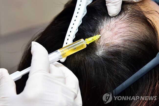 탈모치료. (사진: 연합뉴스)